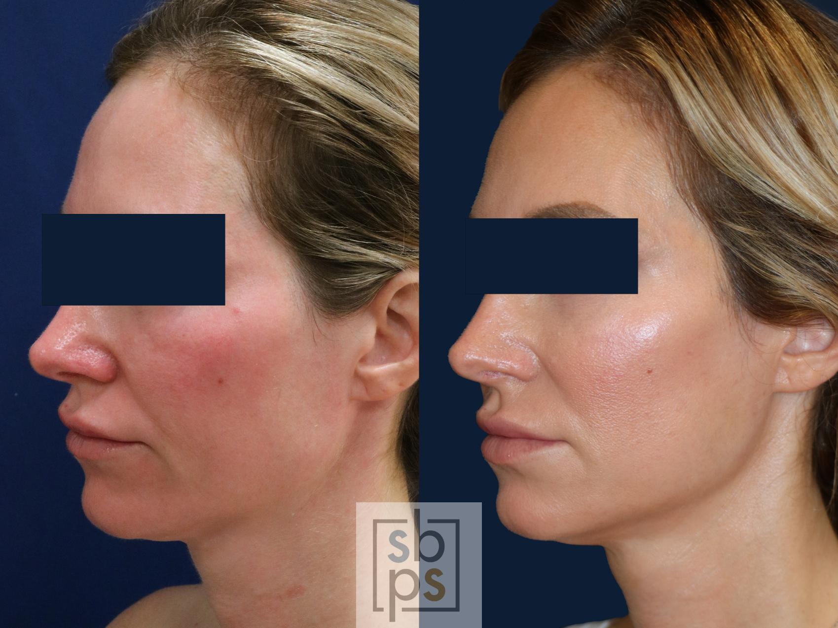 Before & After Dermal Fillers Case 671 Left Oblique View in Torrance & Los Angeles, CA, CA