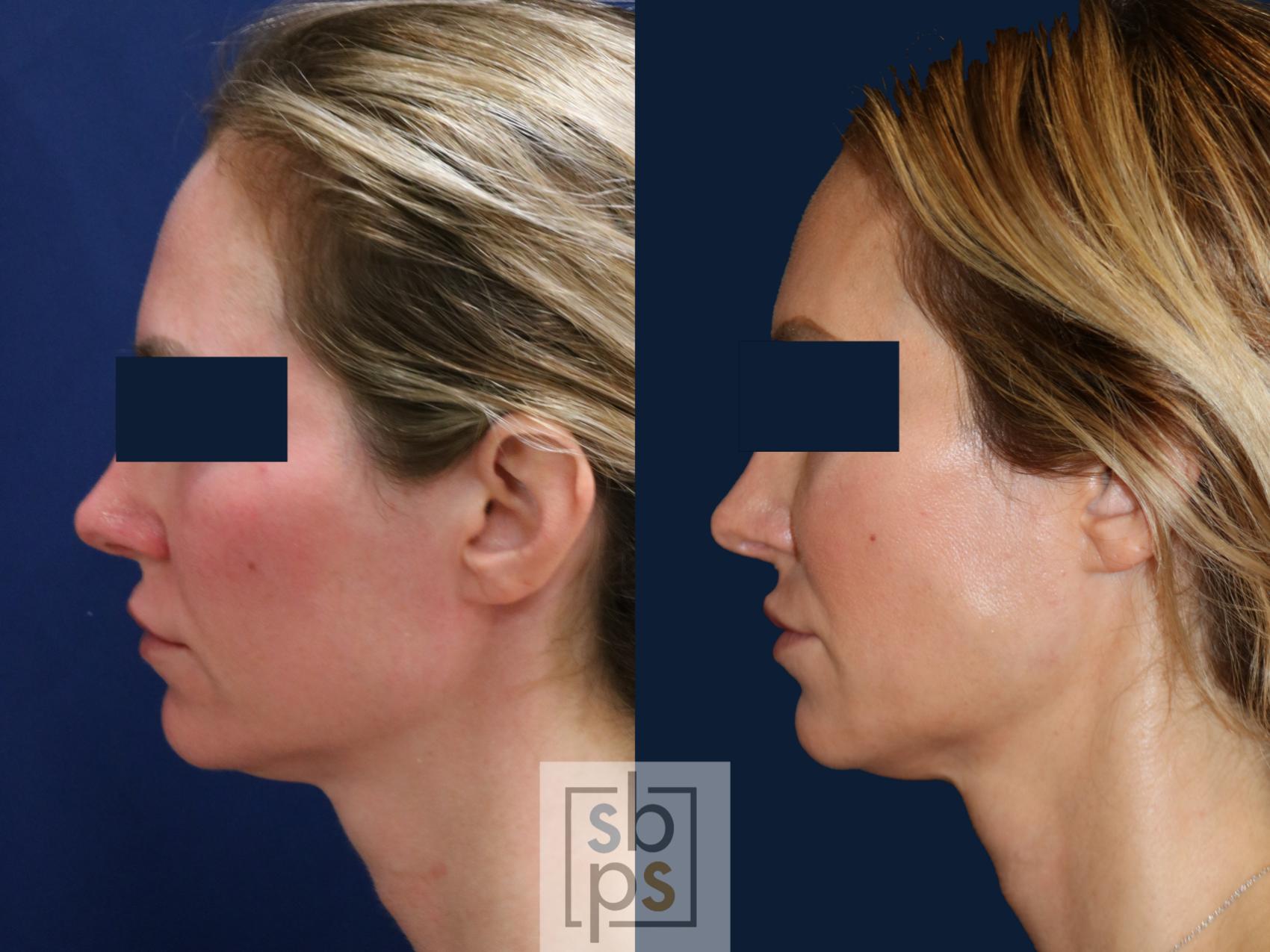 Before & After Dermal Fillers Case 671 Left Side View in Torrance & Los Angeles, CA, CA