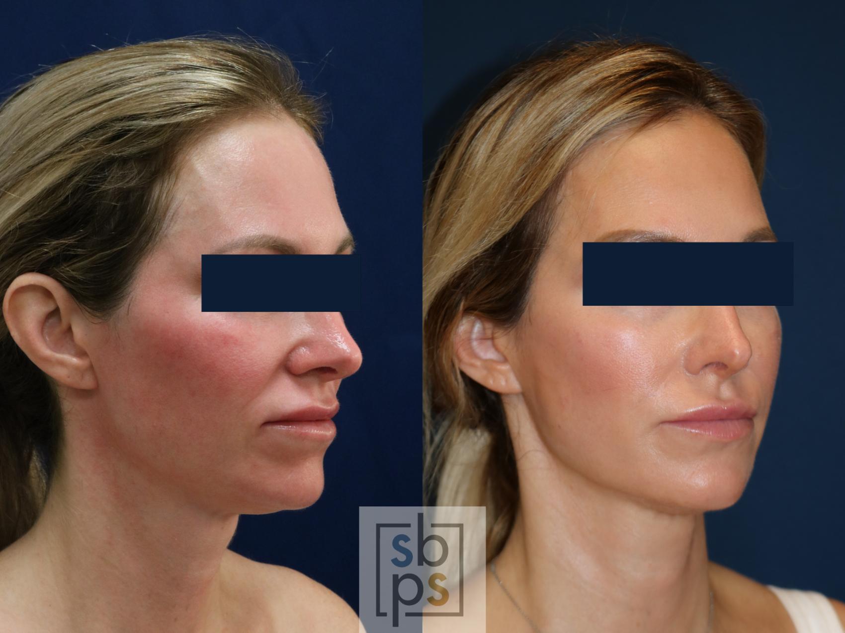 Before & After Dermal Fillers Case 671 Right Oblique View in Torrance & Los Angeles, CA, CA