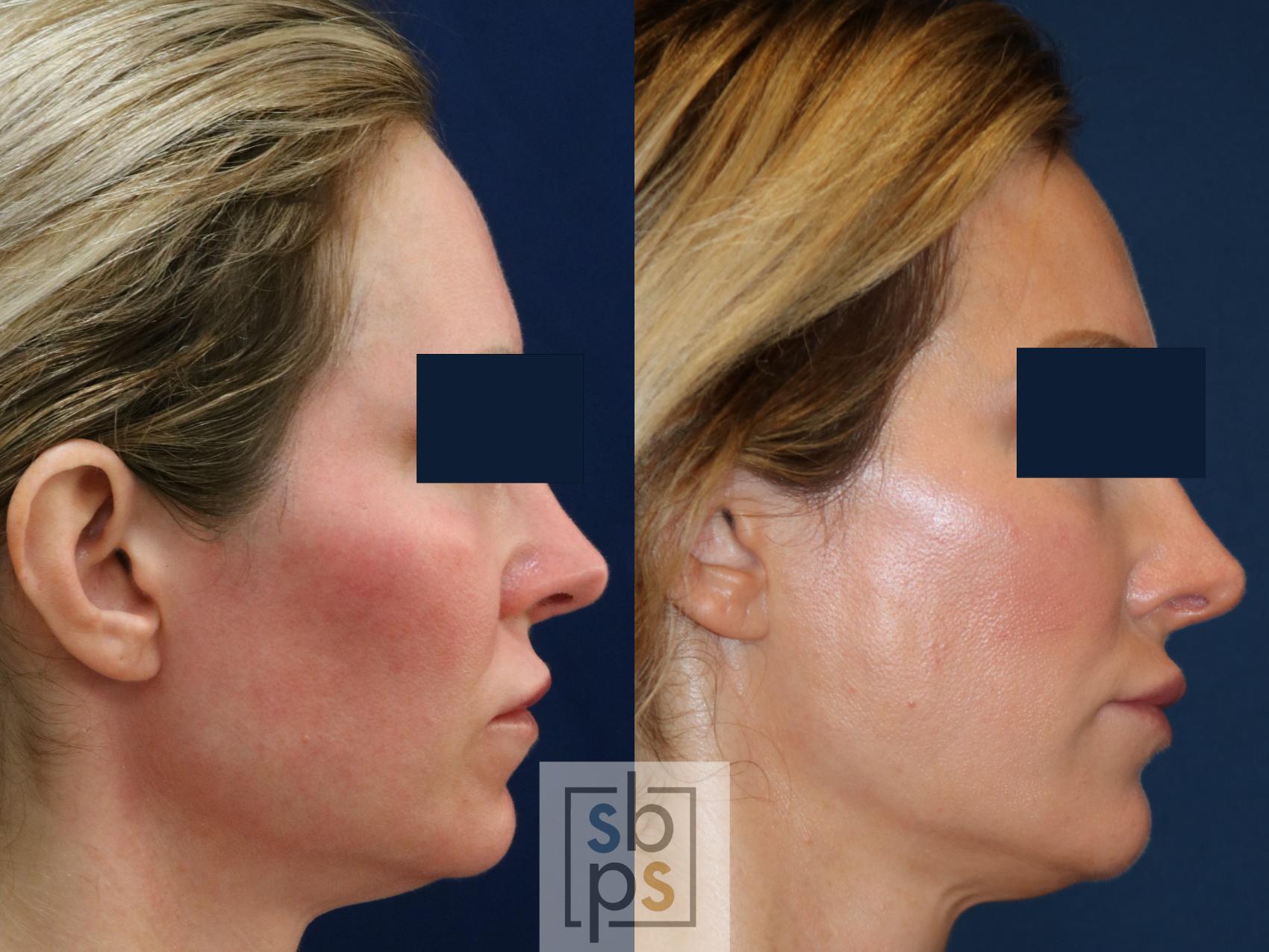 Before & After Dermal Fillers Case 671 Right Side View in Torrance & Los Angeles, CA, CA