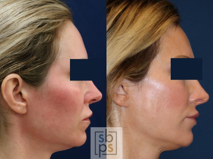 Before & After Dermal Fillers Case 671 Right Side View in Torrance, CA