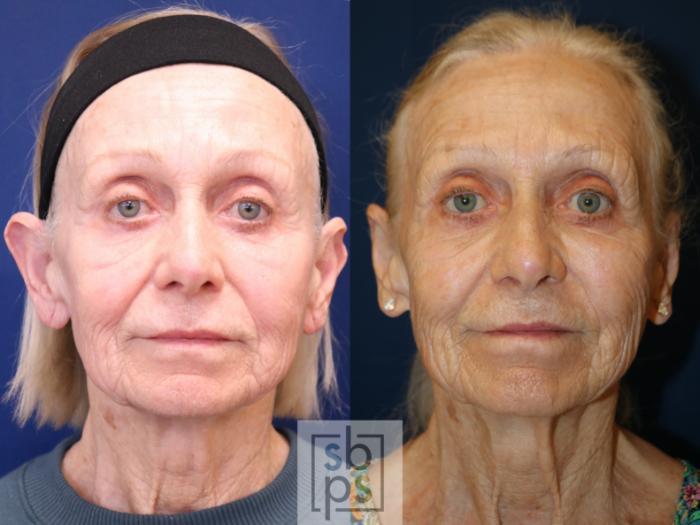 Before & After Ear Surgery (Otoplasty) Case 737 Front View in Los Angeles, Torrance & Long Beach, CA