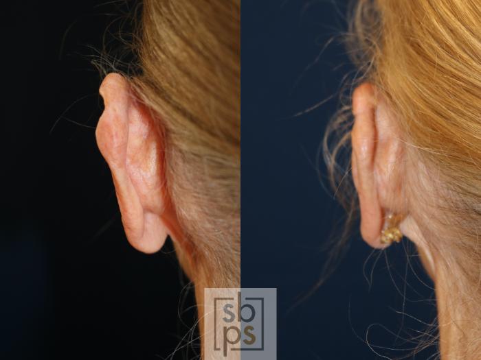 Before & After Ear Surgery (Otoplasty) Case 737 Left Side View in Los Angeles, Torrance & Long Beach, CA