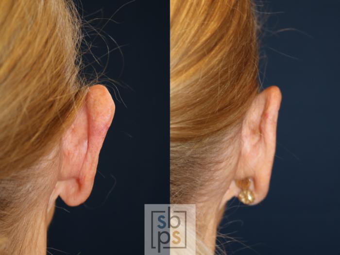 Before & After Ear Surgery (Otoplasty) Case 737 Right Side View in Los Angeles, Torrance & Long Beach, CA