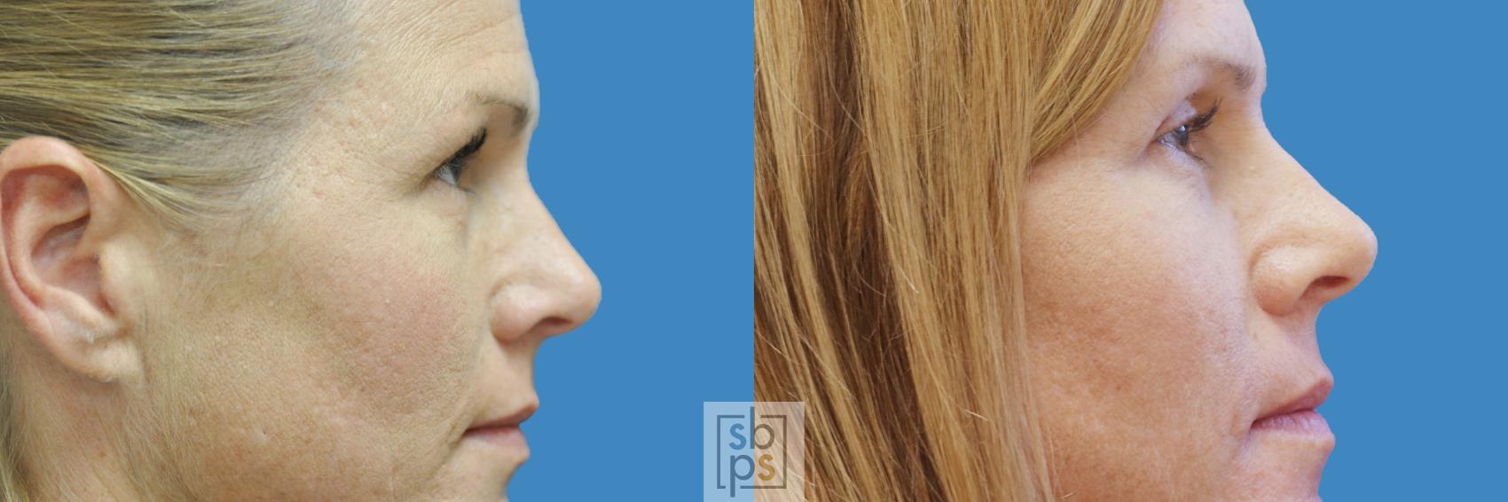 Before & After Eyelid Surgery (Blepharoplasty) Case 208 View #2 View in Torrance & Los Angeles, CA, CA
