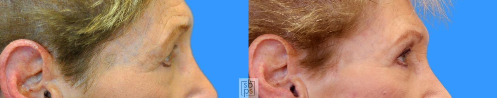 Before & After Eyelid Surgery (Blepharoplasty) Case 219 View #2 View in Los Angeles, Torrance & Long Beach, CA