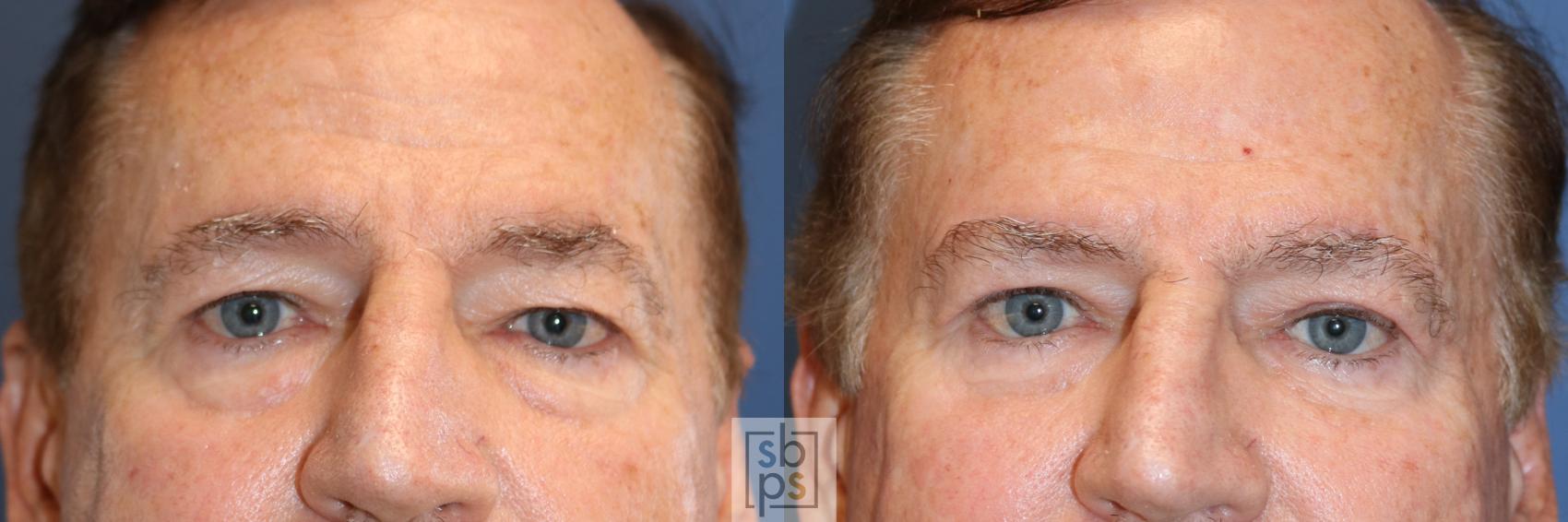 Before & After Eyelid Surgery (Blepharoplasty) Case 342 View #1 View in Torrance, CA