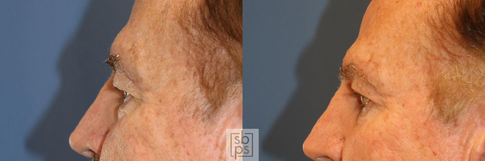 Before & After Eyelid Surgery (Blepharoplasty) Case 342 View #2 View in Torrance & Los Angeles, CA, CA