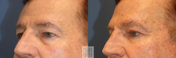 Before & After Eyelid Surgery (Blepharoplasty) Case 342 View #3 View in Torrance, CA