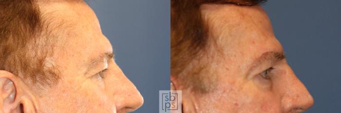 Before & After Eyelid Surgery (Blepharoplasty) Case 342 View #4 View in Torrance, CA