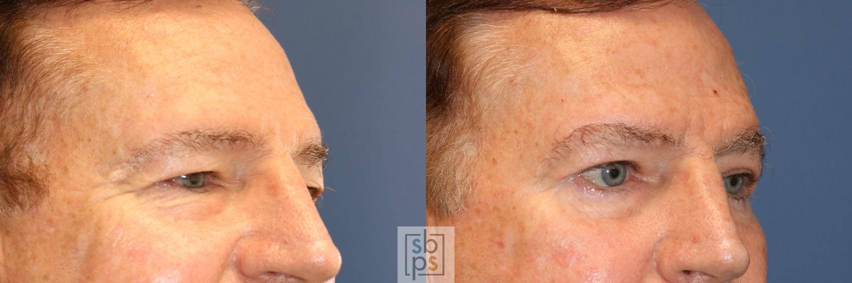 Before & After Eyelid Surgery (Blepharoplasty) Case 342 View #5 View in Torrance & Los Angeles, CA, CA