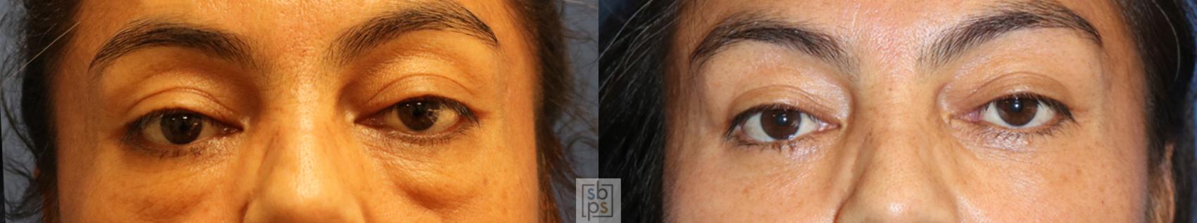 Before & After Eyelid Surgery (Blepharoplasty) Case 344 View #1 View in Torrance, CA