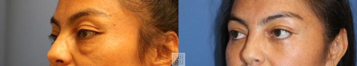 Before & After Eyelid Surgery (Blepharoplasty) Case 344 View #3 View in Torrance, CA