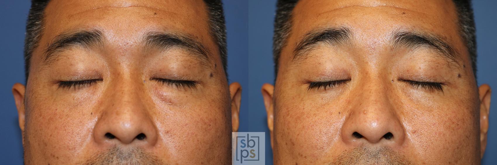 Before & After Eyelid Surgery (Blepharoplasty) Case 357 View #1 View in Torrance, CA