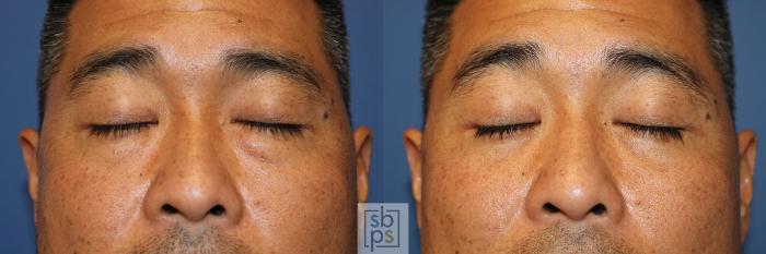 Before & After Eyelid Surgery (Blepharoplasty) Case 357 View #1 View in Torrance, CA