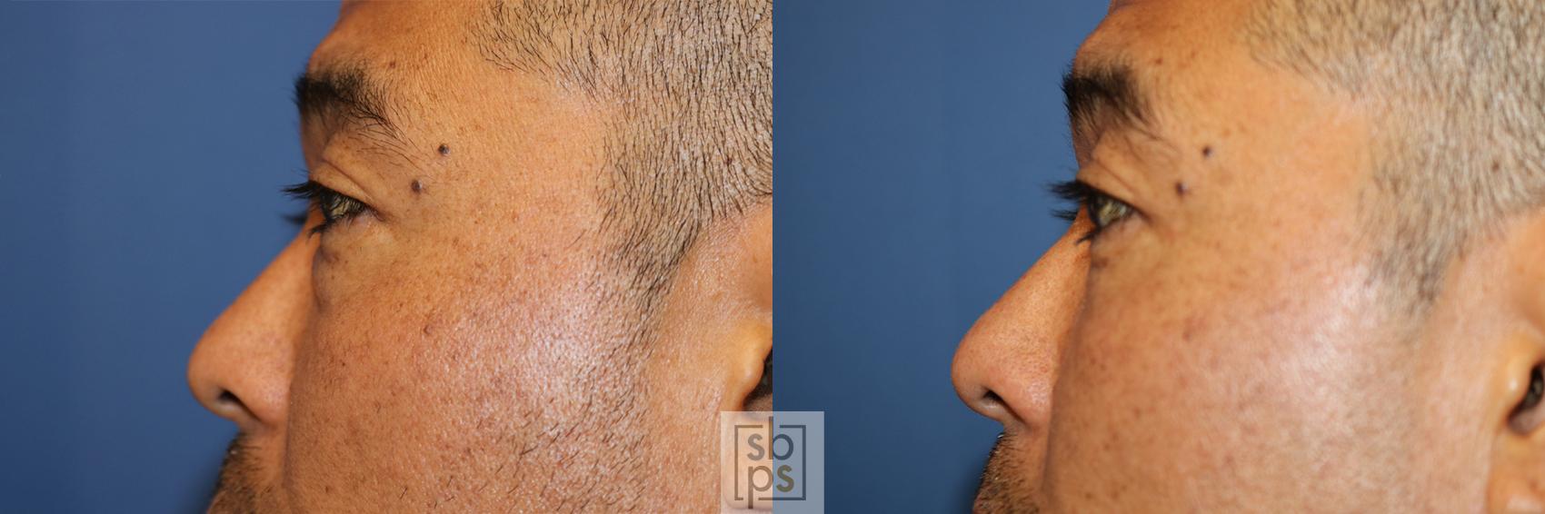 Before & After Eyelid Surgery (Blepharoplasty) Case 357 View #2 View in Torrance & Los Angeles, CA, CA