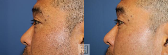 Before & After Eyelid Surgery (Blepharoplasty) Case 357 View #2 View in Torrance, CA