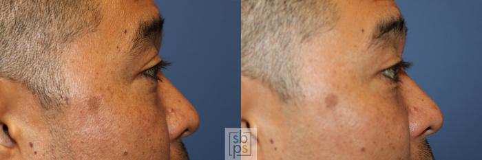Before & After Eyelid Surgery (Blepharoplasty) Case 357 View #3 View in Torrance, CA