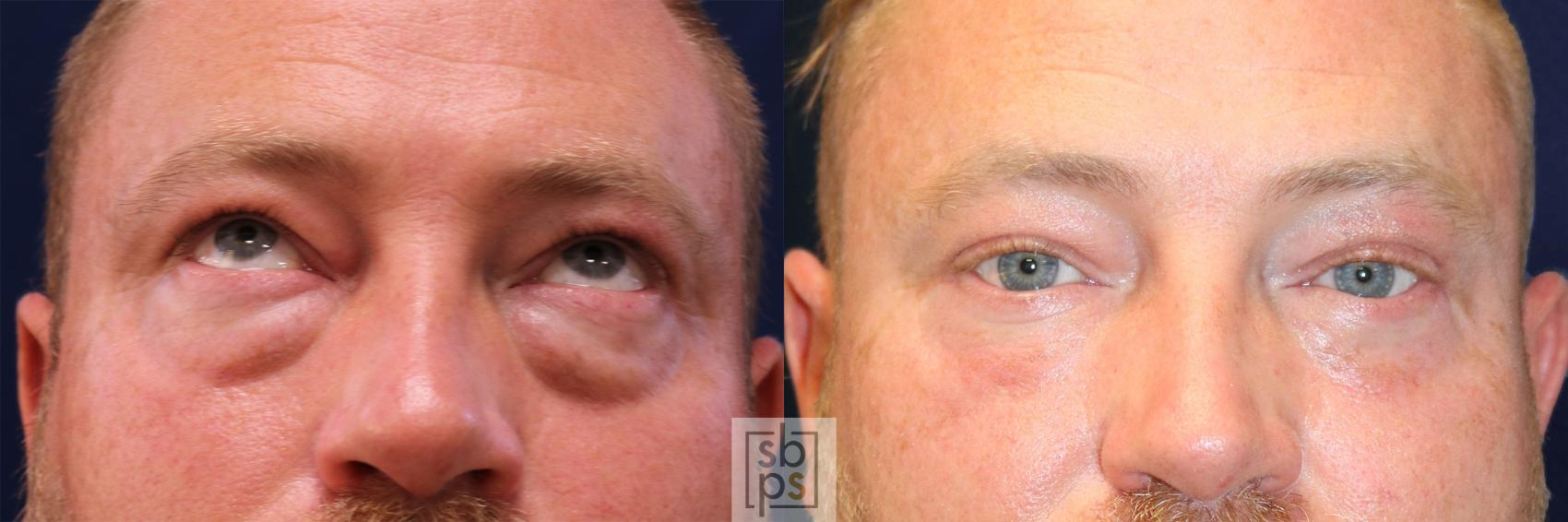 Before & After Eyelid Surgery (Blepharoplasty) Case 558 Front View in Torrance, CA
