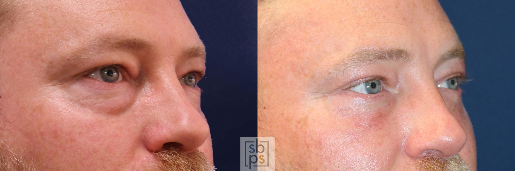 Before & After Eyelid Surgery (Blepharoplasty) Case 558 Left Oblique View in Torrance & Los Angeles, CA, CA
