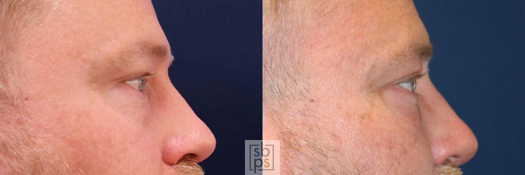 Before & After Eyelid Surgery (Blepharoplasty) Case 558 Left Side View in Torrance & Los Angeles, CA, CA