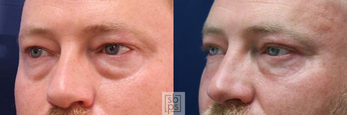 Before & After Eyelid Surgery (Blepharoplasty) Case 558 Right Oblique View in Torrance, CA