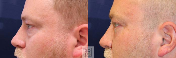 Before & After Eyelid Surgery (Blepharoplasty) Case 558 Right Side View in Torrance, CA
