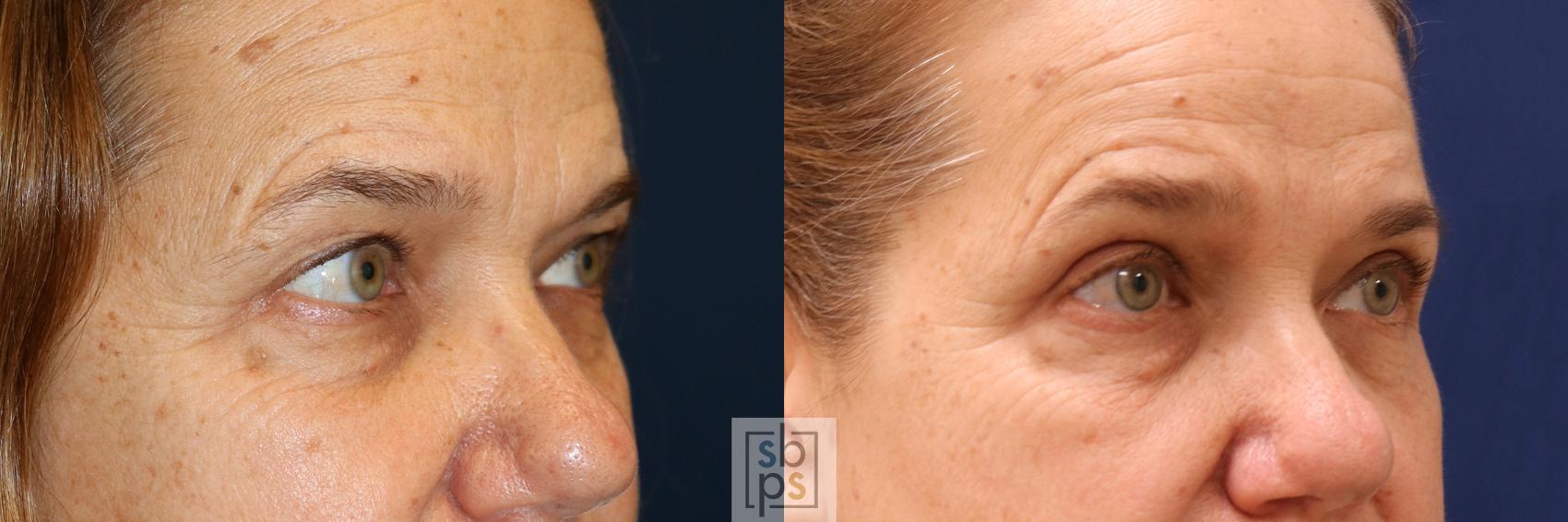 Before & After Eyelid Surgery (Blepharoplasty) Case 562 Left Oblique View in Torrance & Los Angeles, CA, CA
