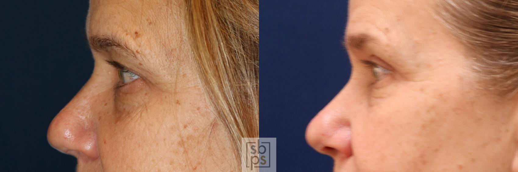 Before & After Eyelid Surgery (Blepharoplasty) Case 562 Left Side View in Torrance & Los Angeles, CA, CA