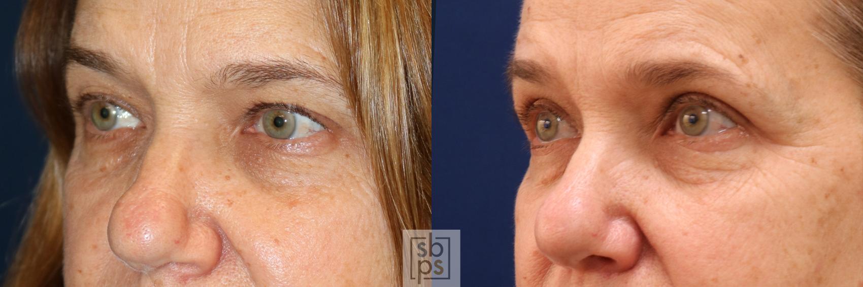 Before & After Eyelid Surgery (Blepharoplasty) Case 562 Right Oblique View in Torrance & Los Angeles, CA, CA