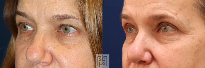 Before & After Eyelid Surgery (Blepharoplasty) Case 562 Right Oblique View in Torrance, CA