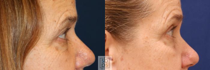 Before & After Eyelid Surgery (Blepharoplasty) Case 562 Right Side View in Torrance, CA