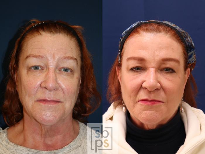 Before & After Eyelid Surgery (Blepharoplasty) Case 585 Front View in Torrance, CA