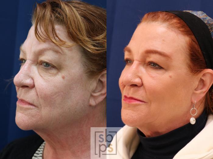 Before & After Eyelid Surgery (Blepharoplasty) Case 585 Left Oblique View in Torrance, CA
