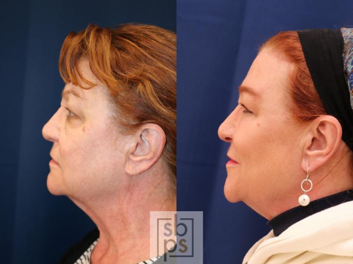 Before & After Eyelid Surgery (Blepharoplasty) Case 585 Left Side View in Torrance, CA