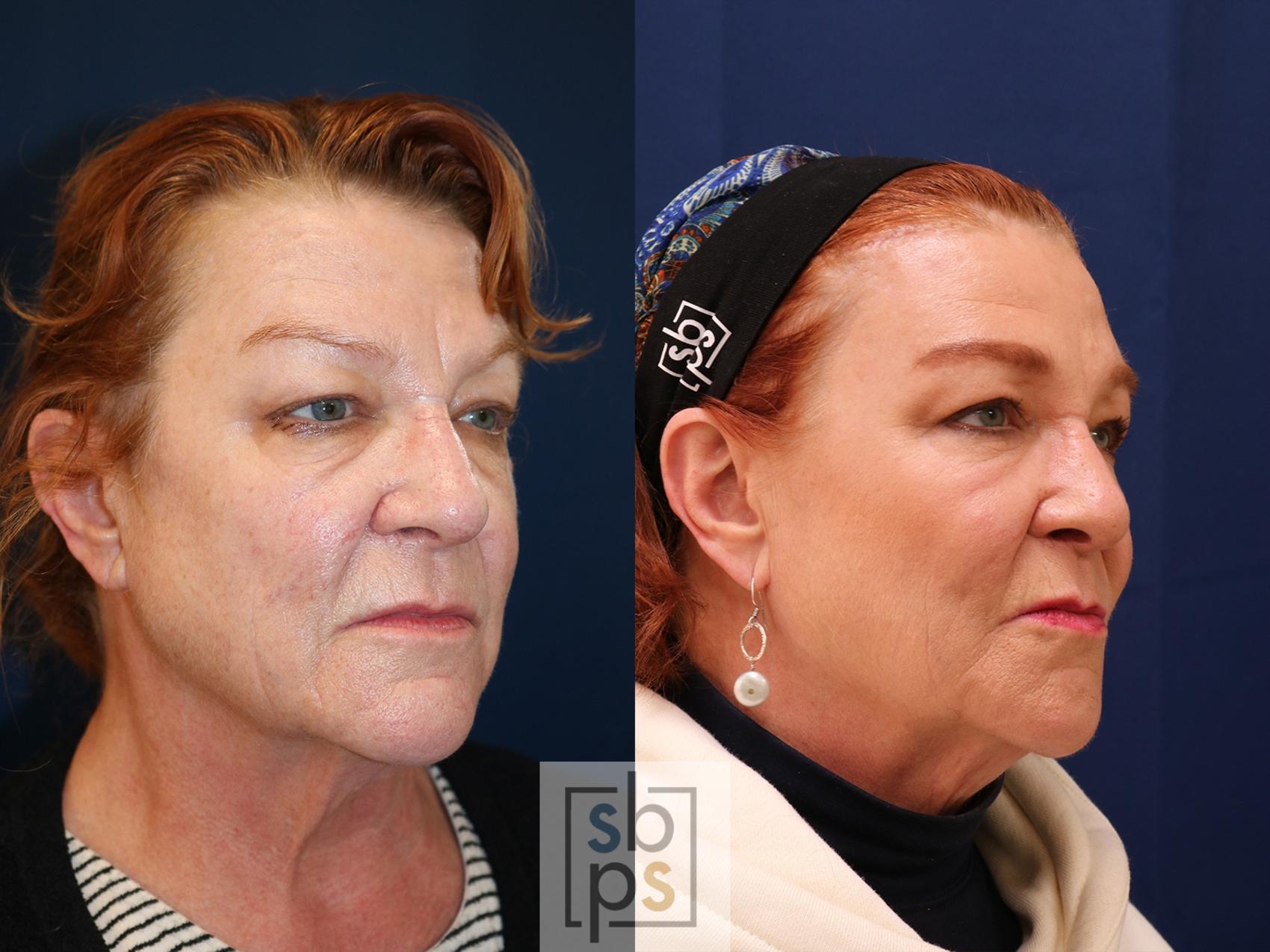 Before & After Brow Lift Case 585 Right Oblique View in Torrance & Los Angeles, CA, CA