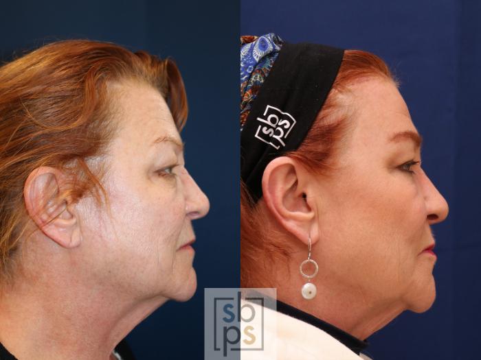 Before & After Eyelid Surgery (Blepharoplasty) Case 585 Right Side View in Torrance, CA