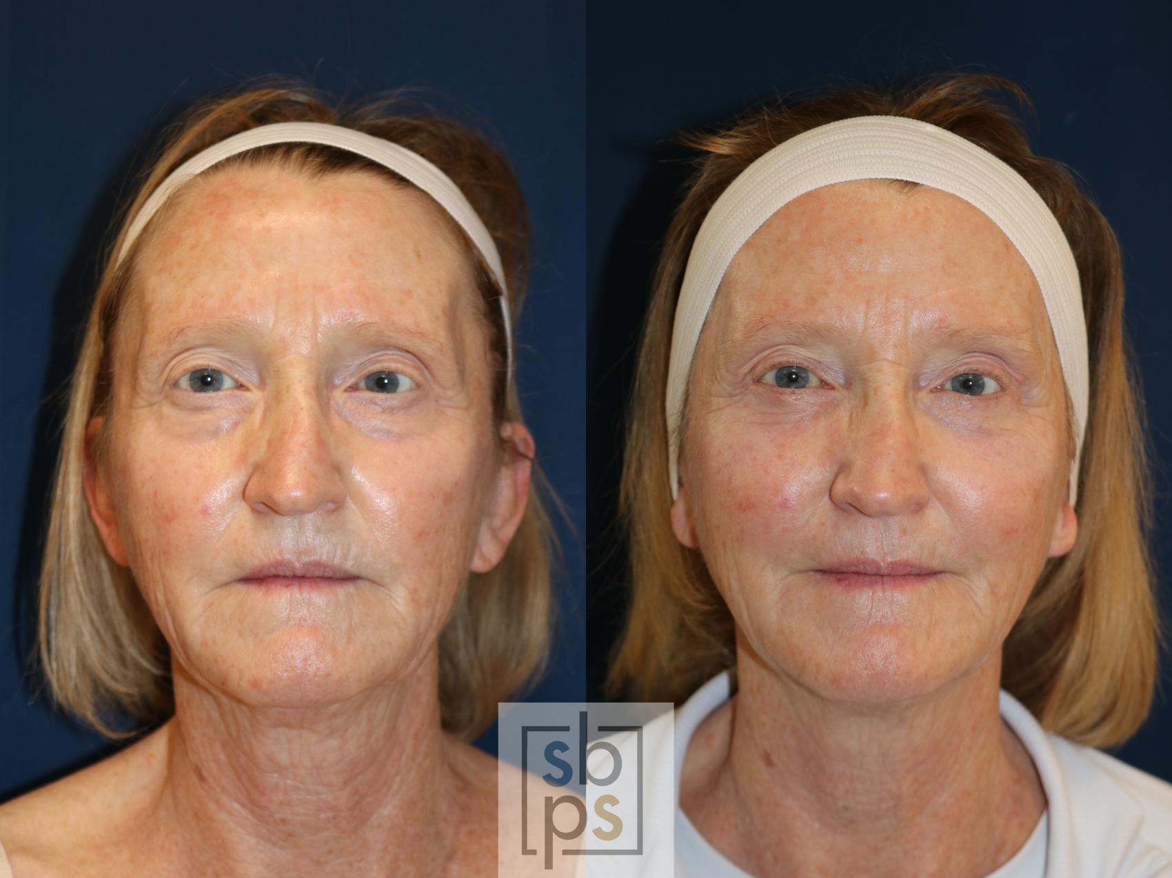 Before & After Eyelid Surgery (Blepharoplasty) Case 735 Front View in Los Angeles, Torrance & Long Beach, CA