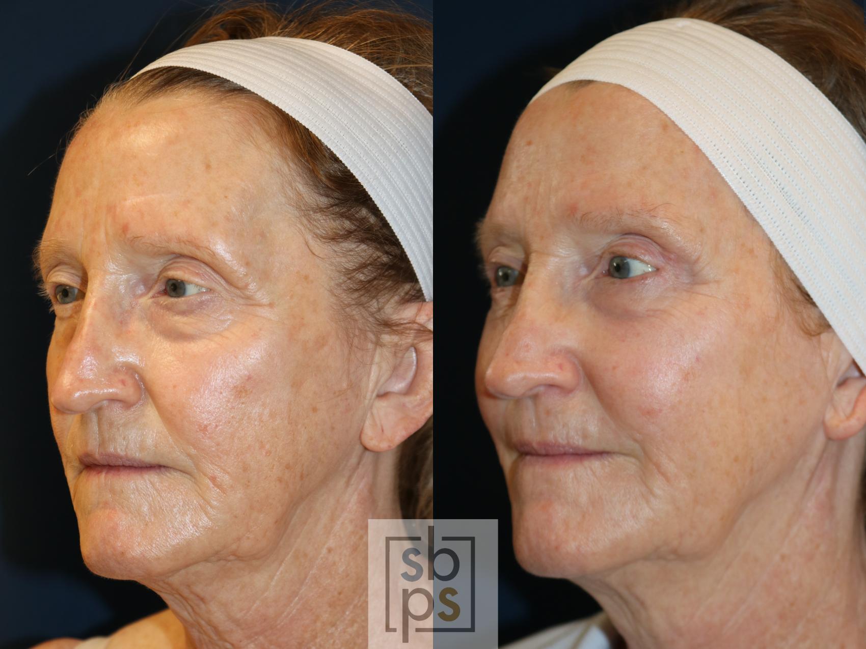 Before & After Eyelid Surgery (Blepharoplasty) Case 735 Left Oblique View in Los Angeles, Torrance & Long Beach, CA