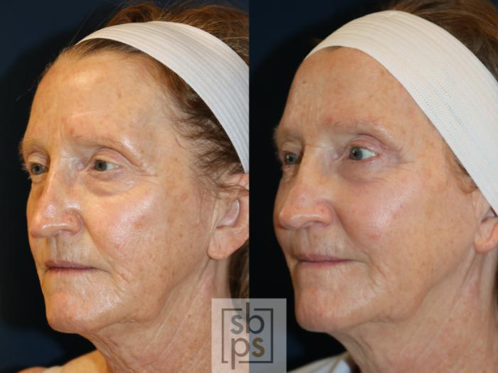 Before & After Eyelid Surgery (Blepharoplasty) Case 735 Left Oblique View in Los Angeles, Torrance & Long Beach, CA
