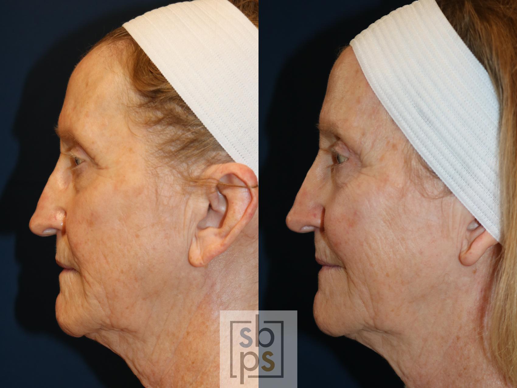 Before & After Eyelid Surgery (Blepharoplasty) Case 735 Left Side View in Los Angeles, Torrance & Long Beach, CA