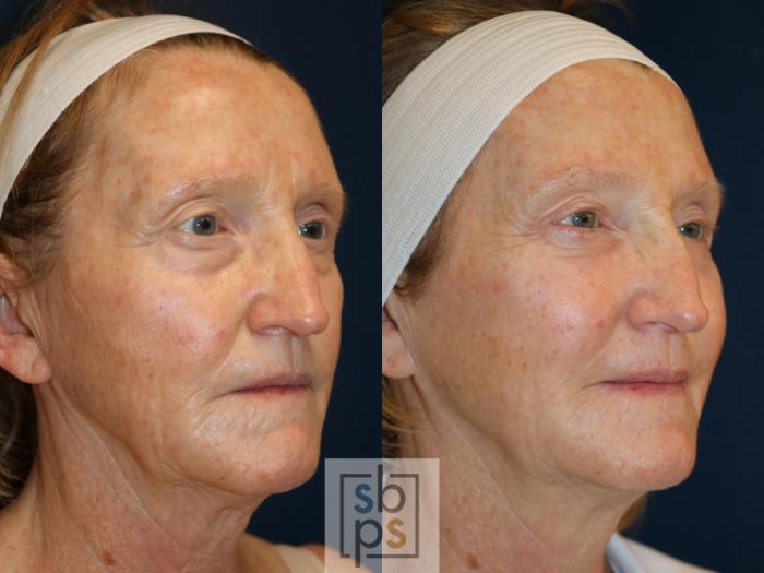 Before & After Eyelid Surgery (Blepharoplasty) Case 735 Right Oblique View in Los Angeles, Torrance & Long Beach, CA