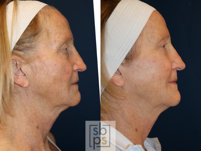 Before & After Eyelid Surgery (Blepharoplasty) Case 735 Right Side View in Los Angeles, Torrance & Long Beach, CA