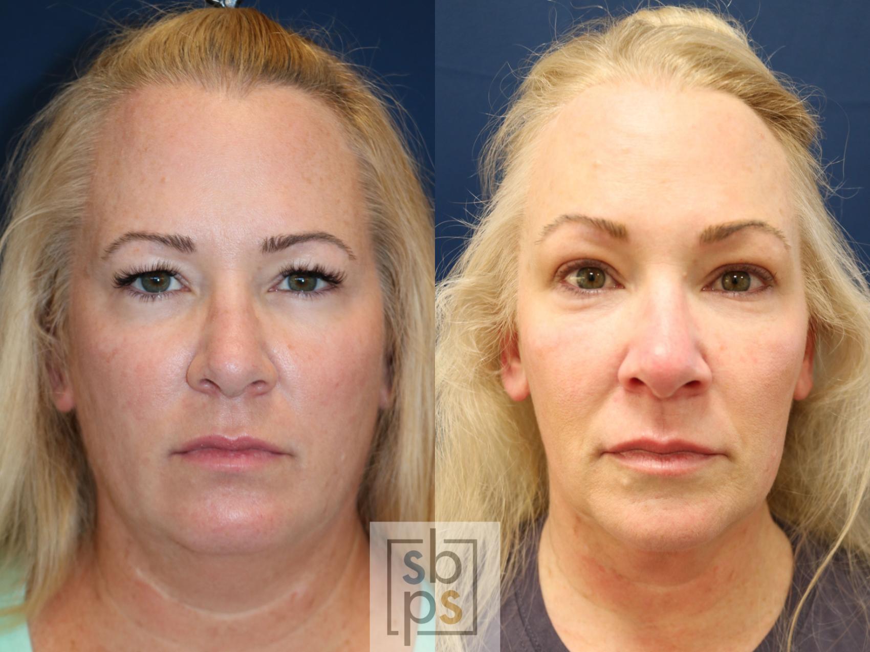 Before & After Eyelid Surgery (Blepharoplasty) Case 747 Front View in Los Angeles, Torrance & Long Beach, CA