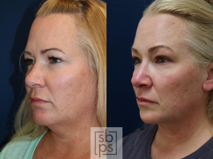 Before & After Brow Lift Case 747 Left Oblique View in Los Angeles, Torrance & Long Beach, CA