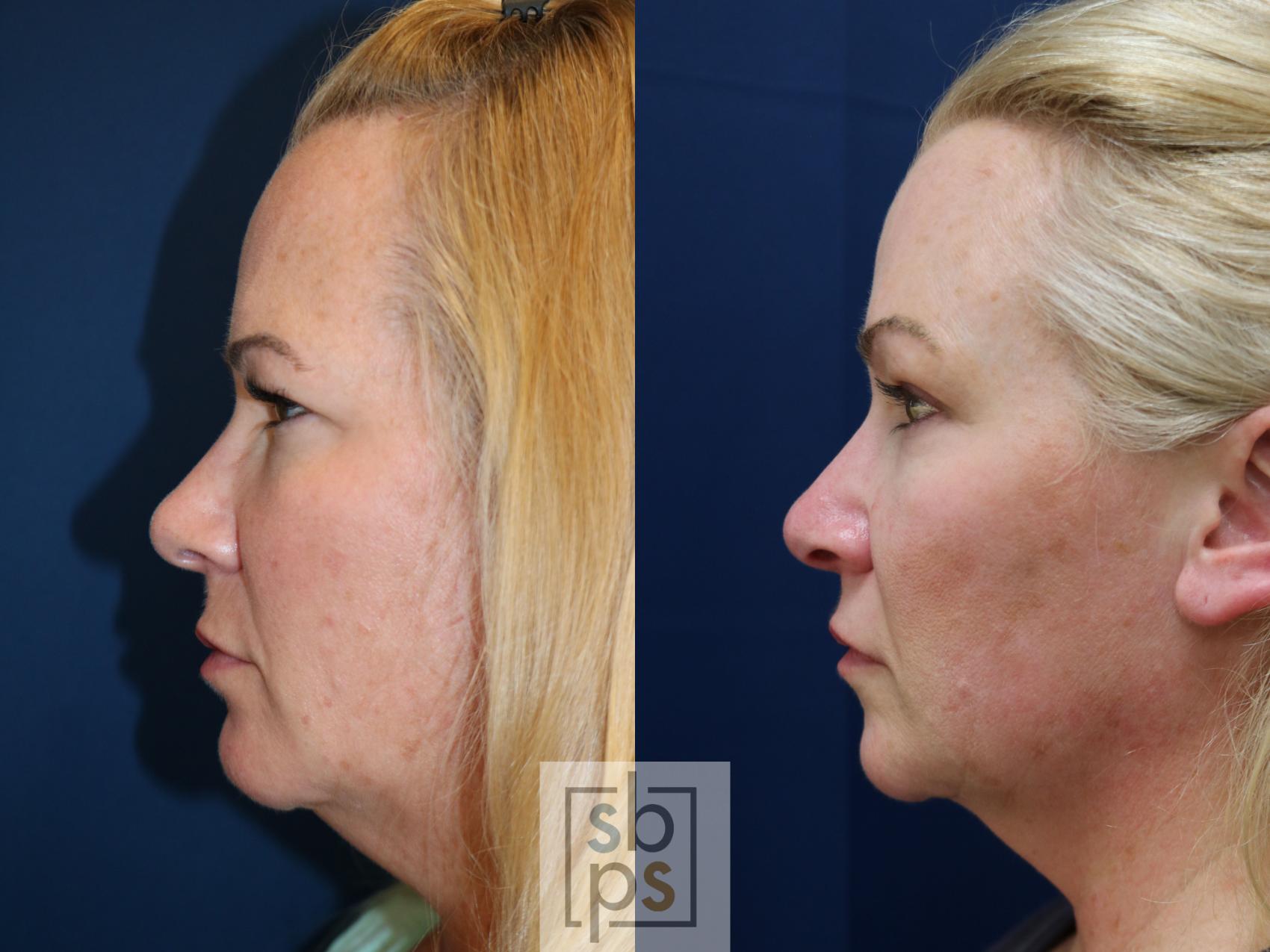 Before & After Brow Lift Case 747 Left Side View in Los Angeles, Torrance & Long Beach, CA