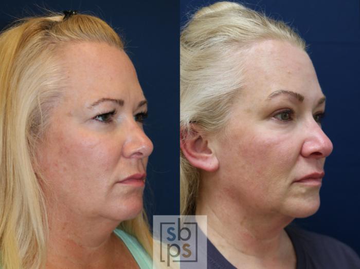 Before & After Brow Lift Case 747 Right Oblique View in Los Angeles, Torrance & Long Beach, CA