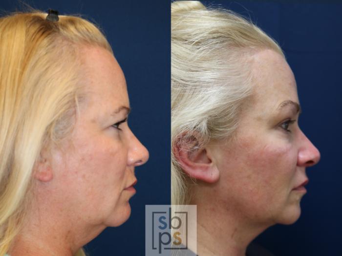 Before & After Brow Lift Case 747 Right Side View in Los Angeles, Torrance & Long Beach, CA