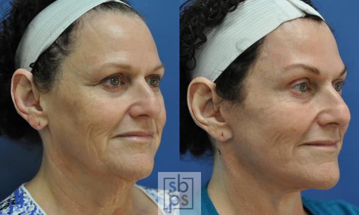 Before & After Facelift Case 195 View #1 View in Torrance, CA