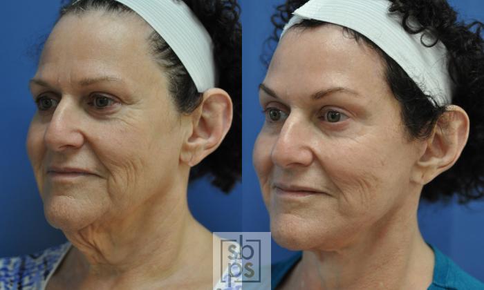 Before & After Facelift Case 195 View #2 View in Torrance, CA
